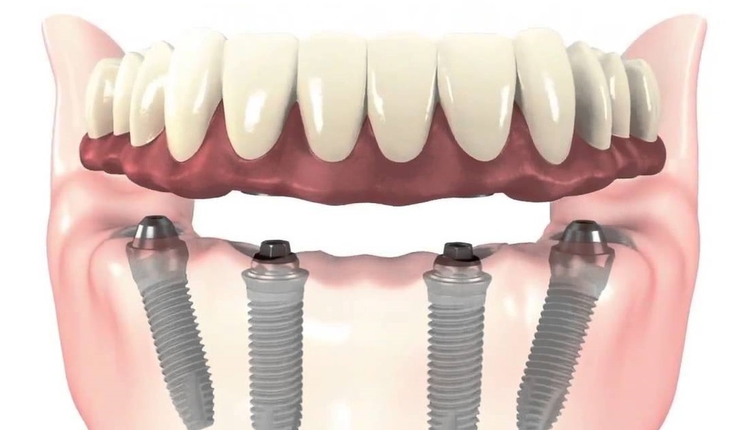 all on four implantes prc3b3tesis implantc3b3logo murcia dentista cirujano bucal oral velez lozano