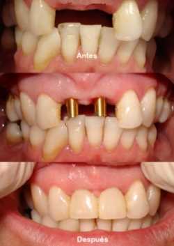 Antes y después de un implante dental