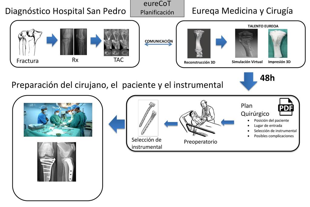 El complejo hospitalario universitario de Cáceres utiliza impresión 3D para replicar huesos y operar fracturas